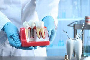 Why Dental Implants Are the Best Solution for Missing Teeth